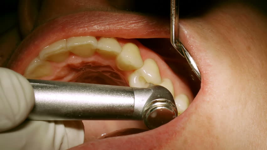 Molars Royalty Free Stock Images Image 332689