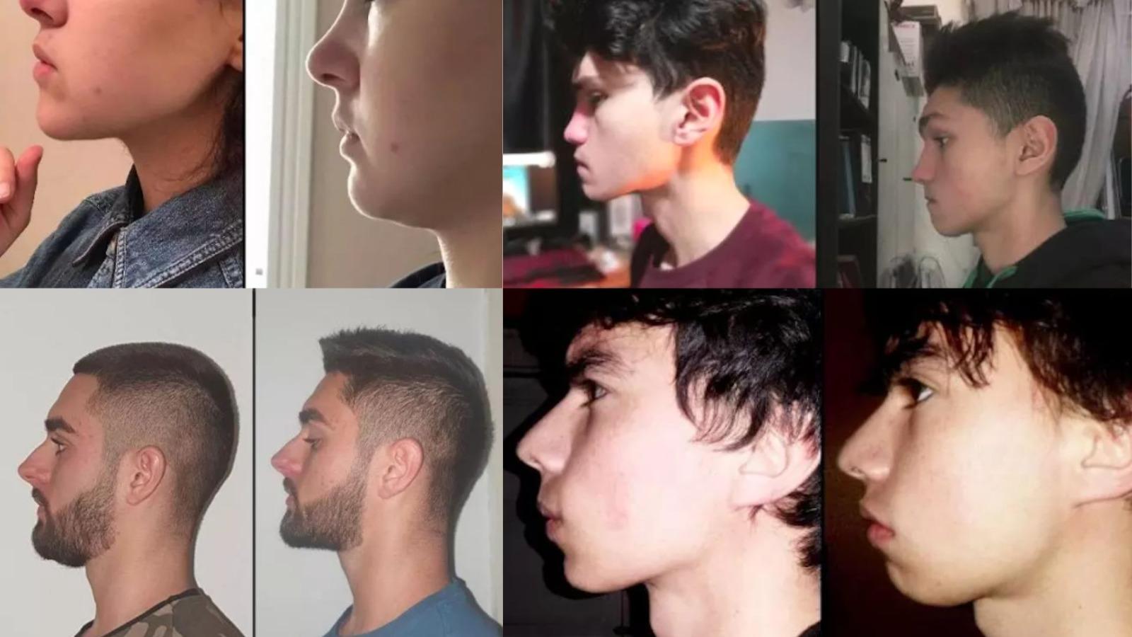 Mewing 15 18 R Mewing