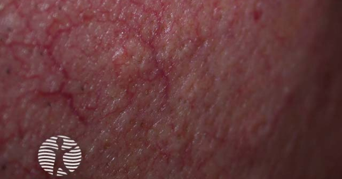 Hyperplasia Of The Sebaceous Gland Arrow With Infiltrating Fibrous