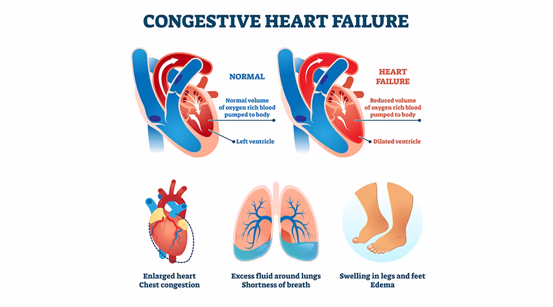 Premium Photo Congestive Heart Failure Signs And Symptoms