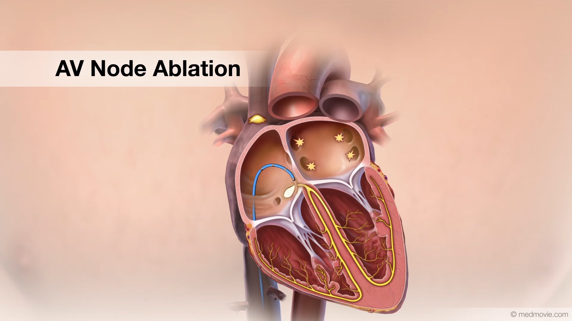 What Is Ablation Geology