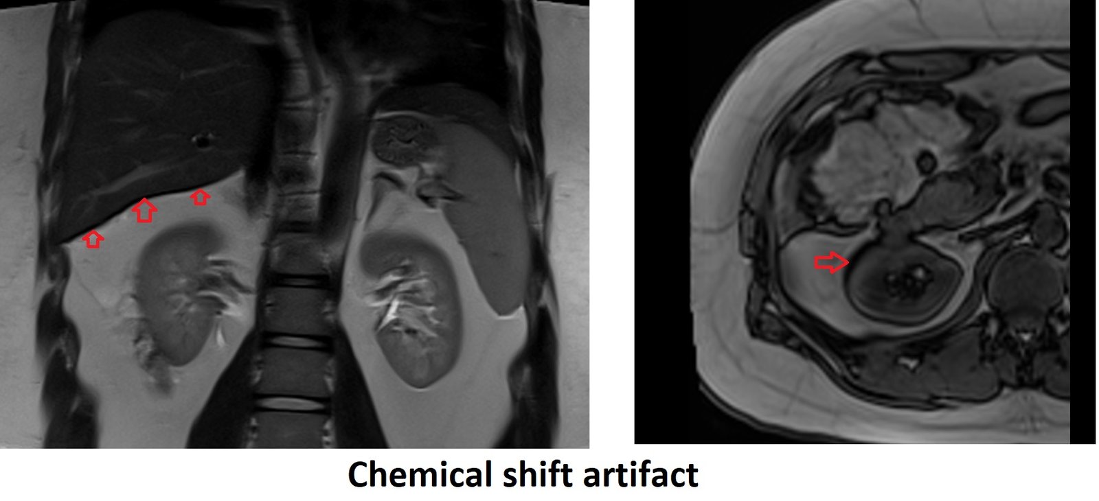 What Is Chemical Shift Mri