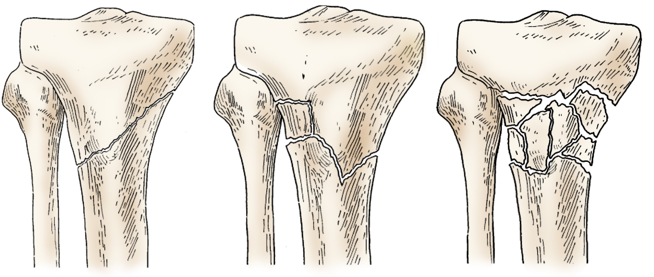 tibial anatomy 