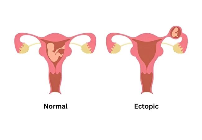Ectopic Expression Of Pdz Rhogef And Rhoa Effector Domain Mutant