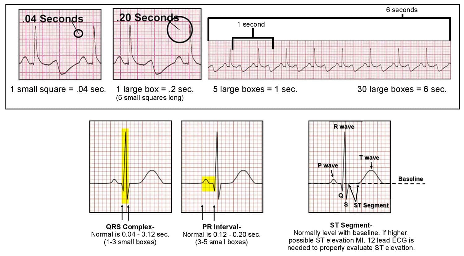 Ecg Signal Classification Monitoring And Alerting System Using
