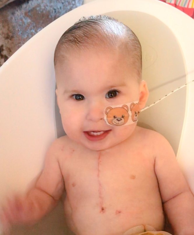 Tetralogy Of Fallot Samson Tiny Tickers